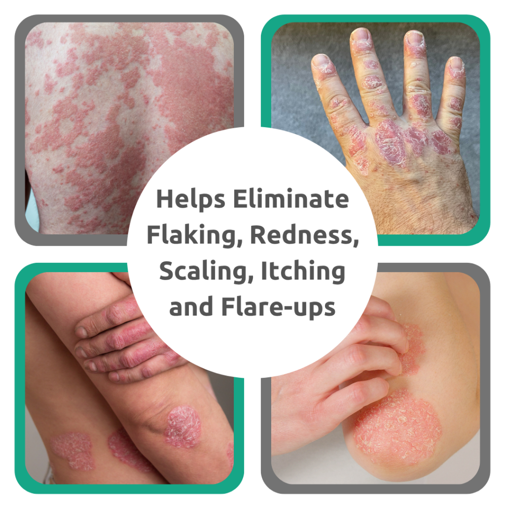 Revitaderm Psoriasis Formula - Image 3