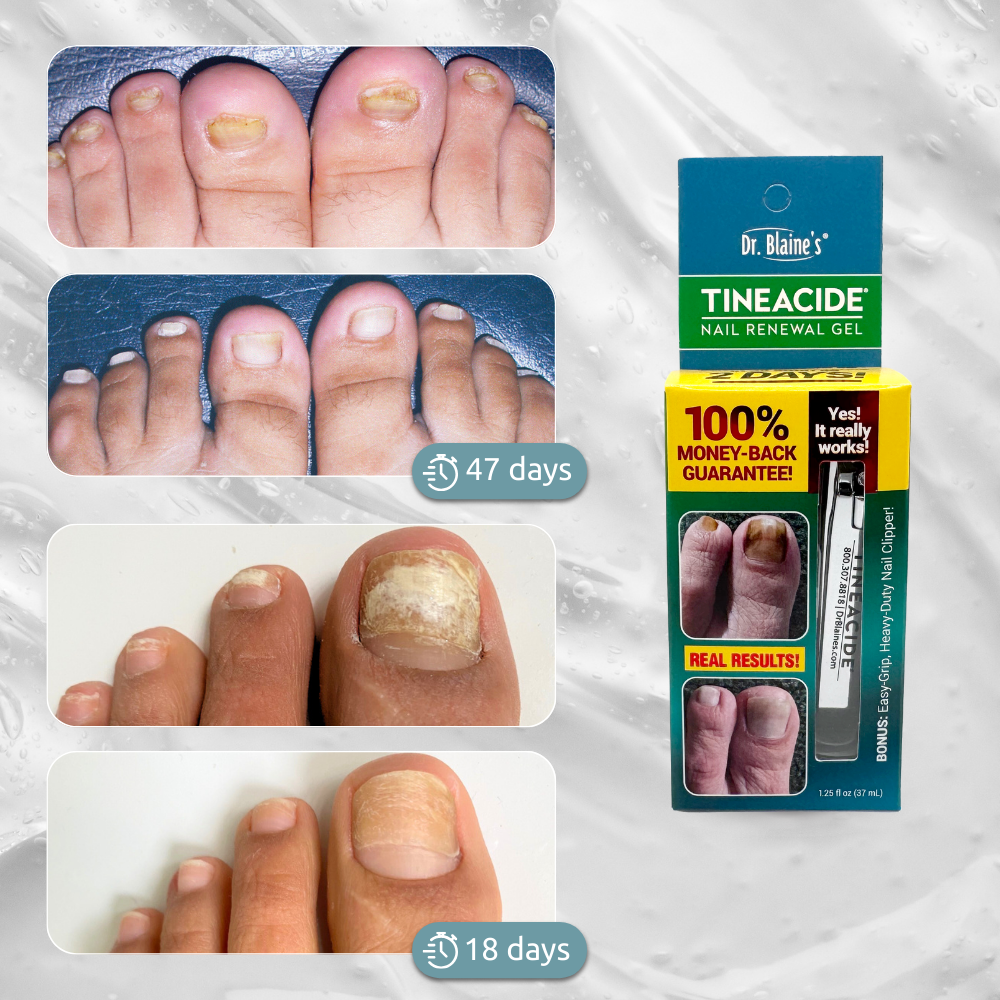 Tineacide Nail Renewal Gel - Image 2